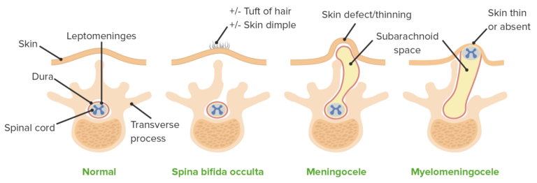 Neural Tube Defects Concise Medical Knowledge