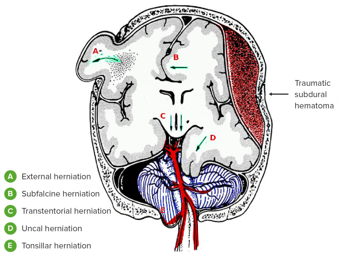 Types of brain herniation