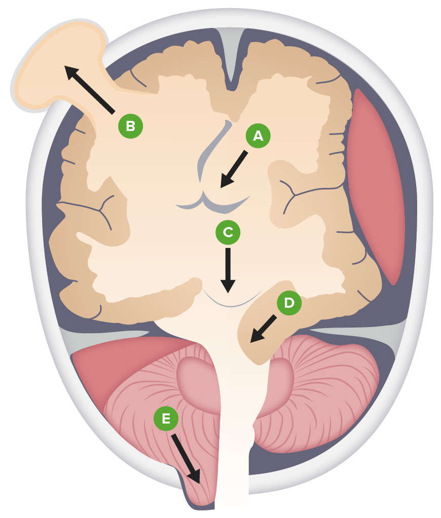 Types of brain herniation