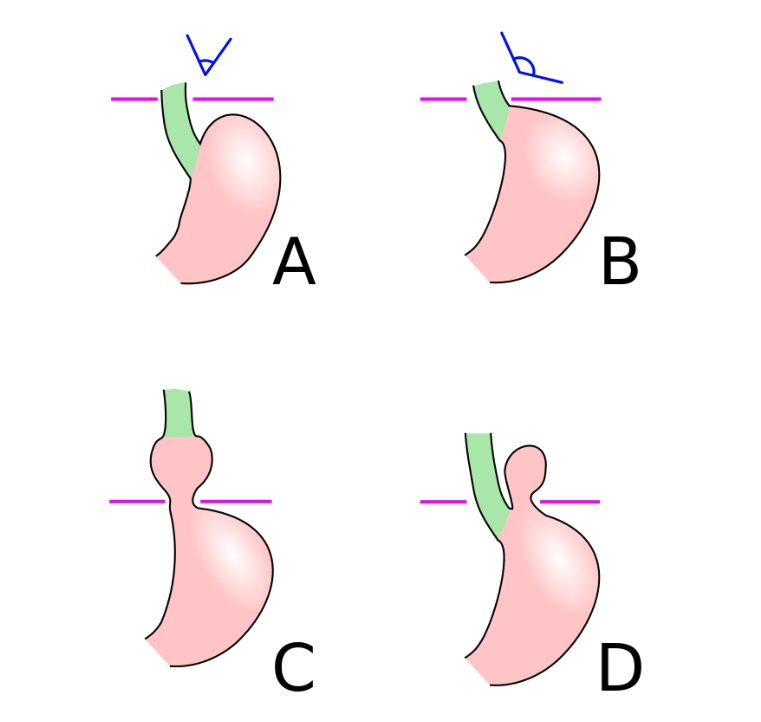 Types of diaphragmatic hernias