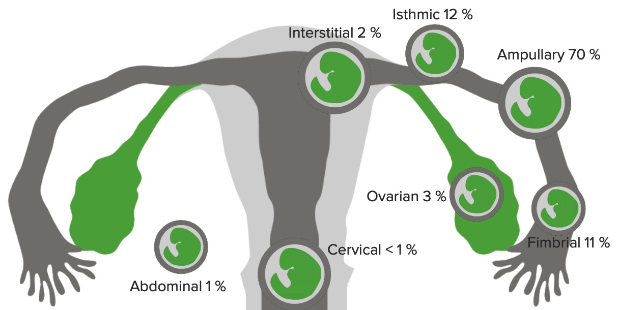 Classification Of Ectopic Pregnancy