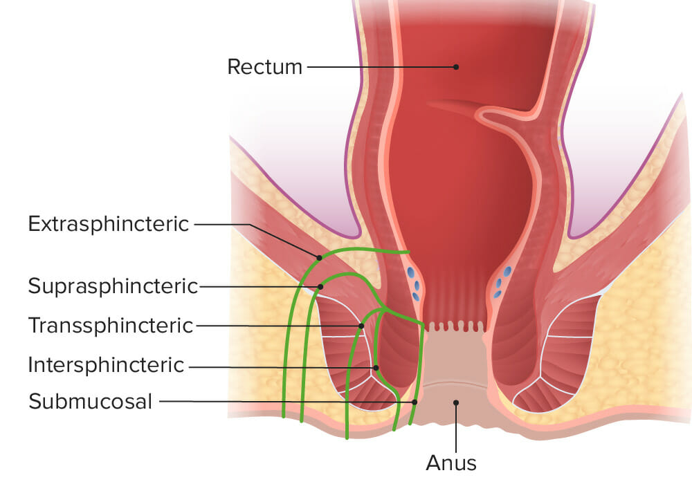 Causas da fistula anal