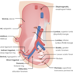 Types of hernias of the abdominal wall