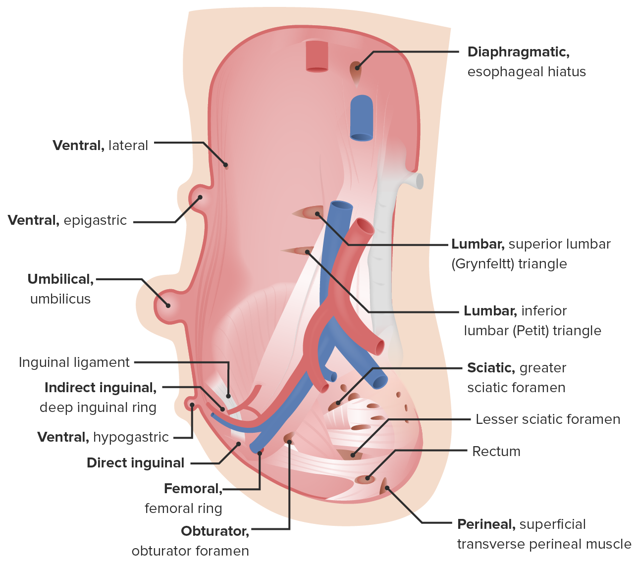 Umbilical and ventral hernia