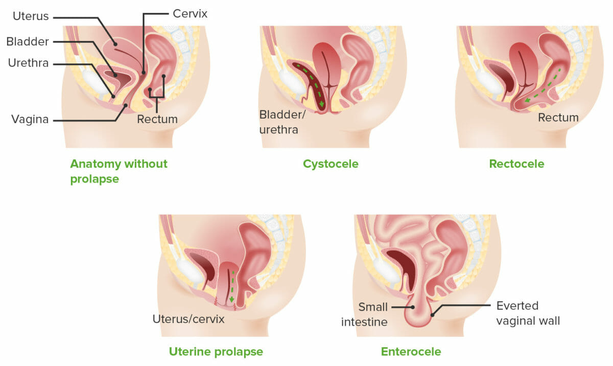 Tipos de prolapso de órganos pélvicos