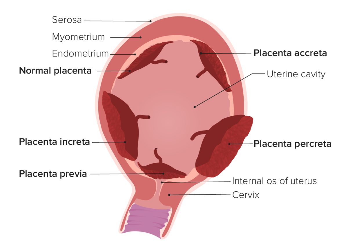 Tipos de invasión de la placenta