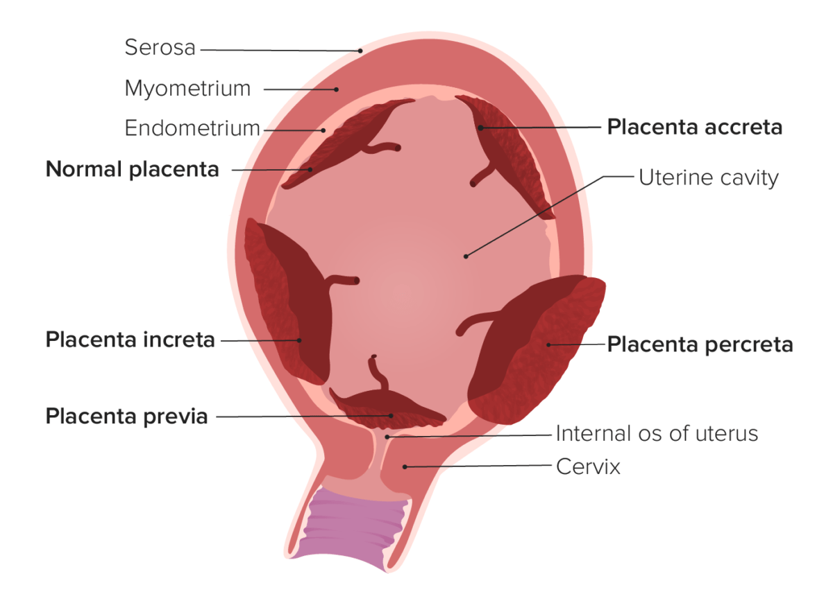 Types of placental invasion