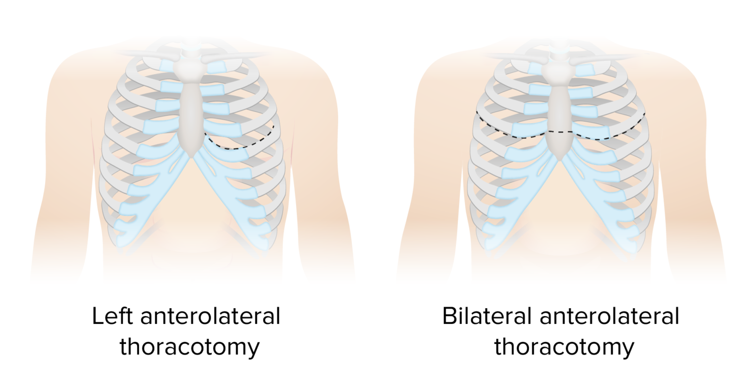 Thoracic Surgery Concise Medical Knowledge