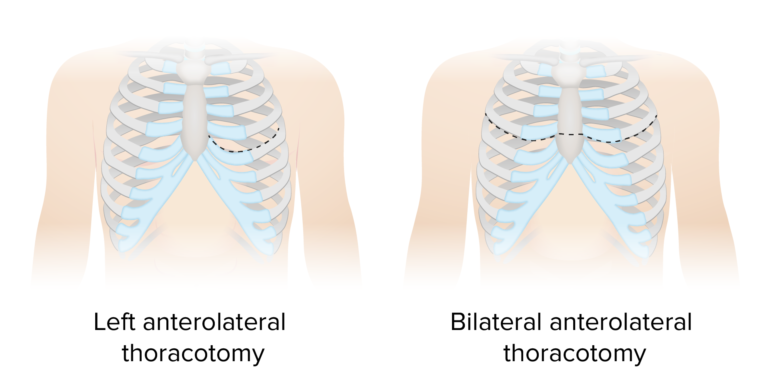 Thoracic Surgery | Concise Medical Knowledge