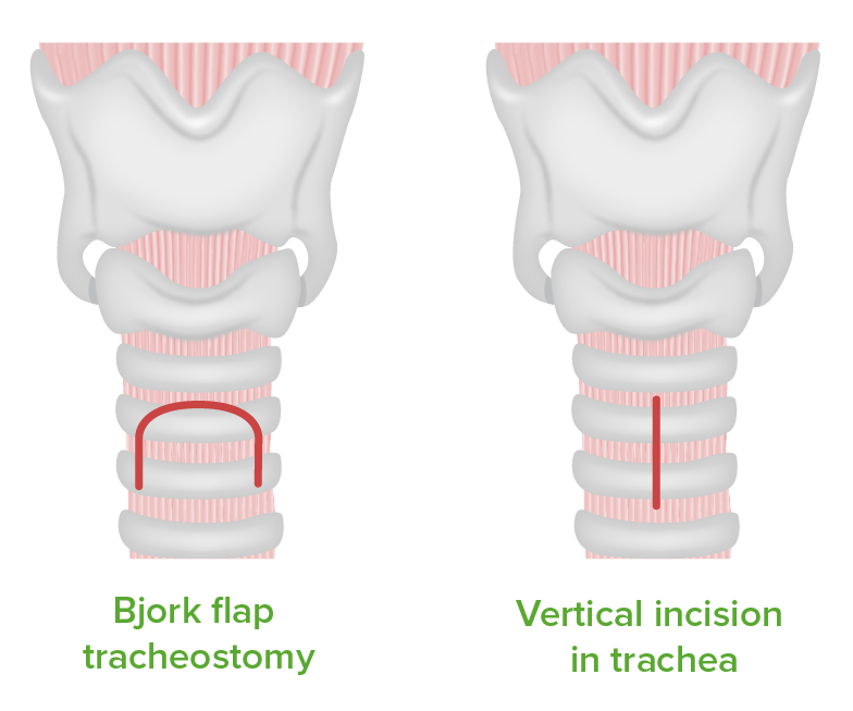Types of tracheotomy incisions