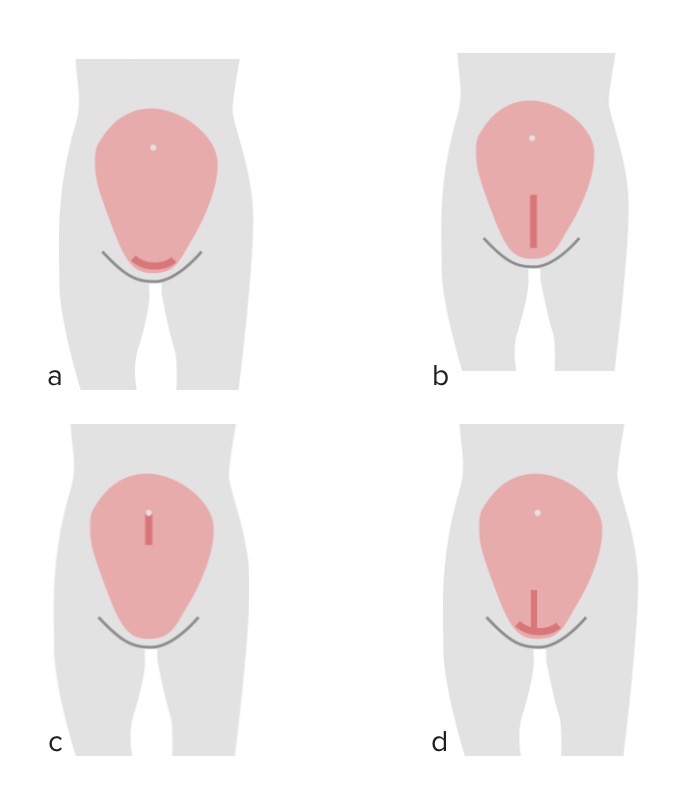 Cesárea x parto normal: qual escolher? MEDPREV