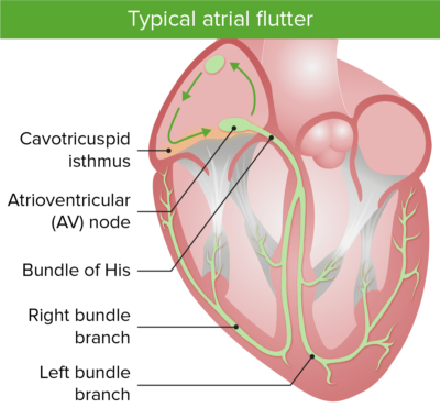 Atrial Flutter | Concise Medical Knowledge