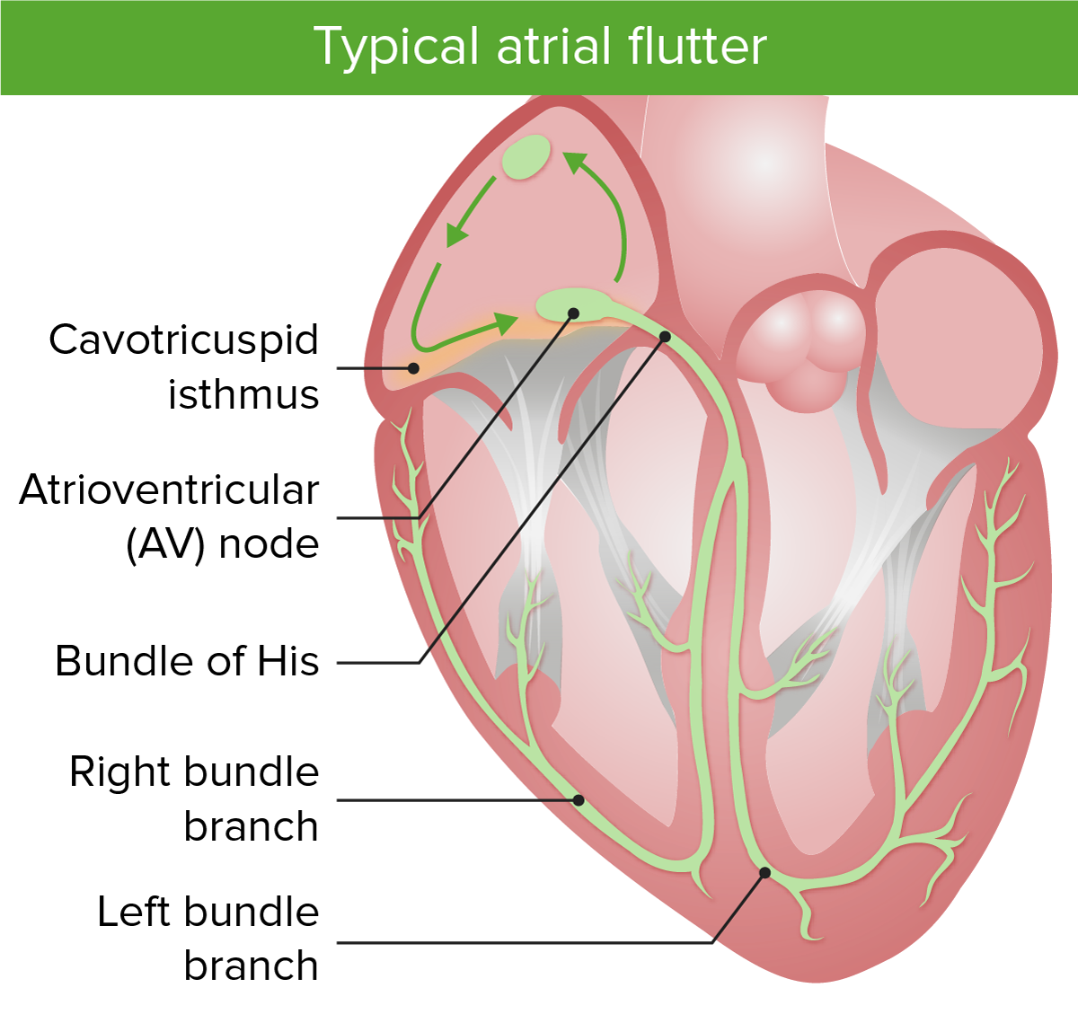 typical atrial flutter