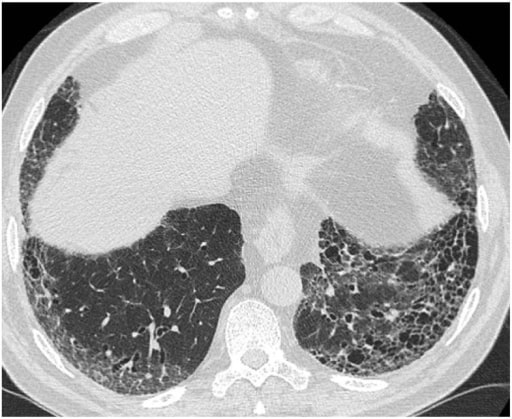 Typical high-resolution computed tomography (hrct) pattern of usual interstitial pneumonia