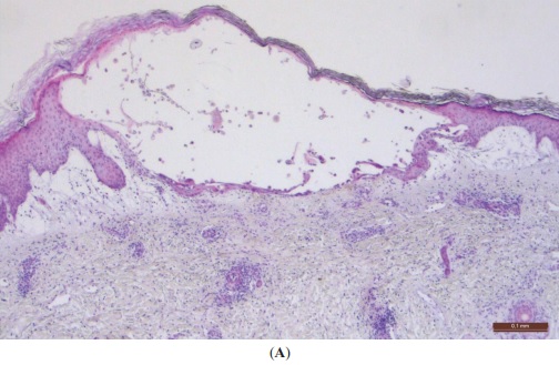Typical histopathological findings a chickenpox varicella zoster virus