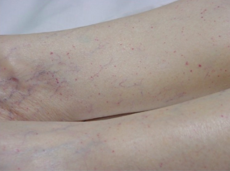 Hematomas De Púrpura Trombocitopênica