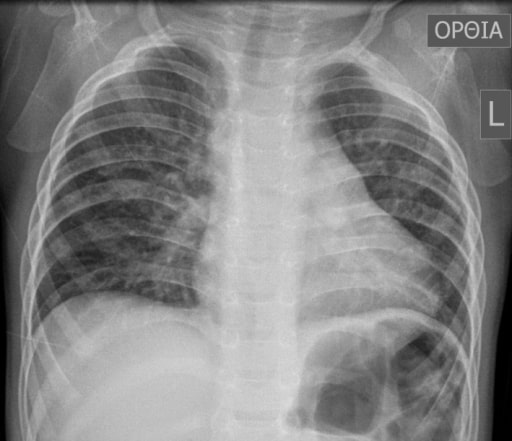 Typical preoperative chest x‐ray of tetralogy of fallot