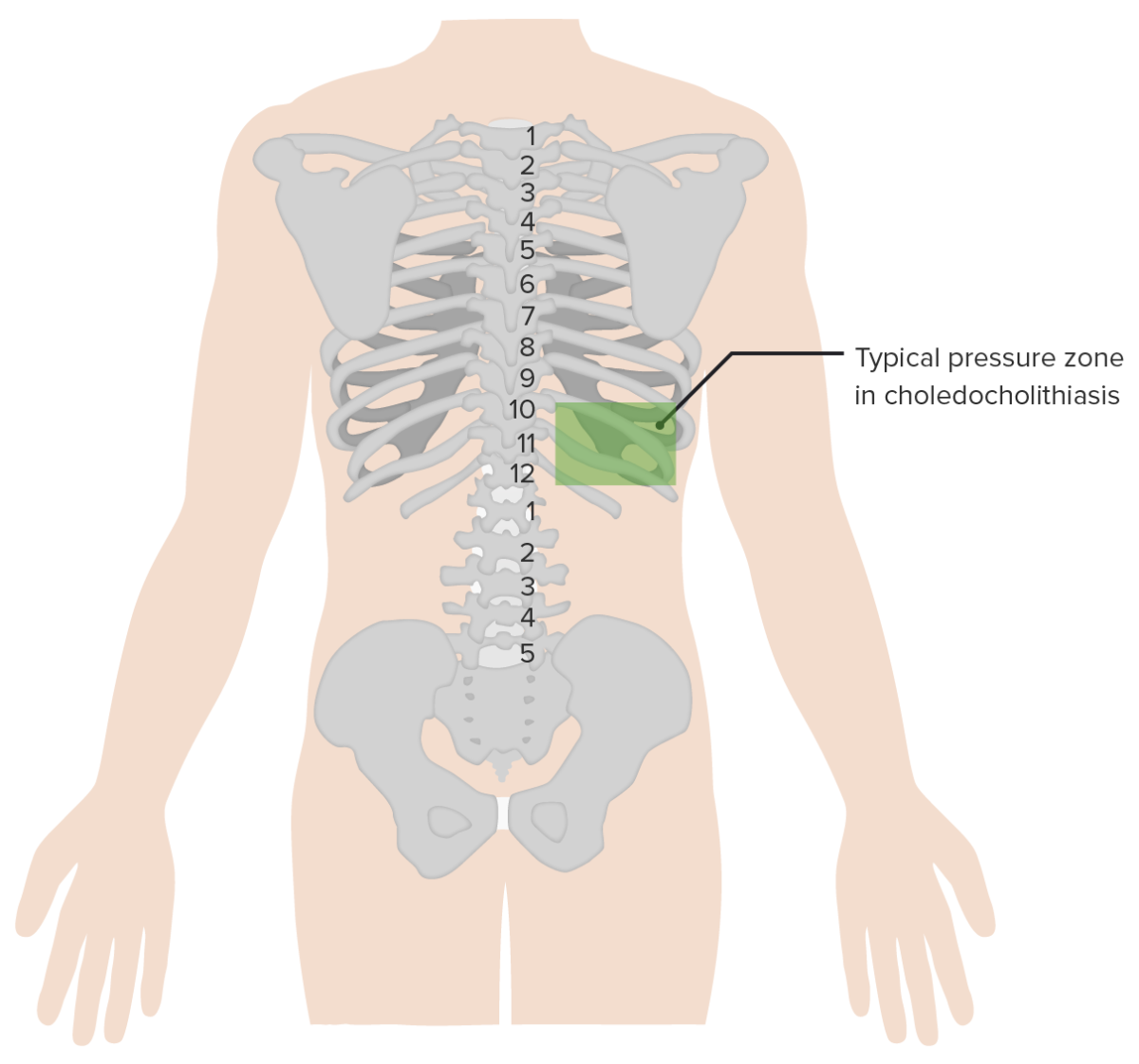 Zona de presión típica en la colelitiasis