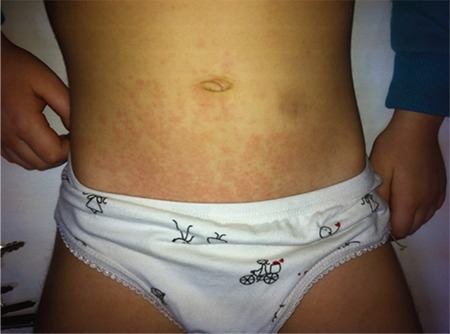 Typical rash in systemic juvenile idiopathic arthritis