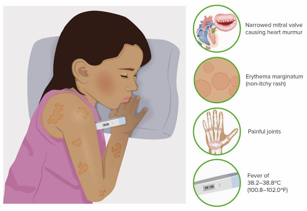 Typical symptoms of rheumatic fever.
