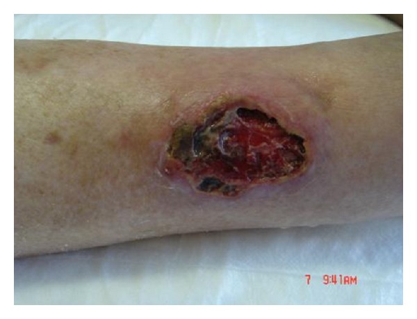 Ulcer from chronic venous stasis