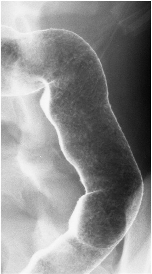 Ulcerative colitis radiograph