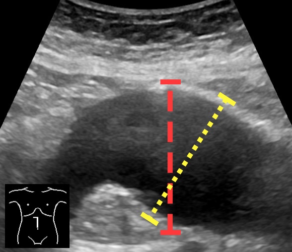Ultrasonography of abdominal aortic aneurysm