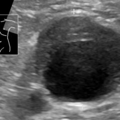 Ultrasonography of abdominal aortic aneurysm