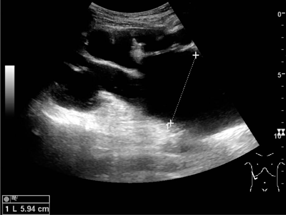 Ultrasonography of end-stage hydronephrosis with cortical thinning