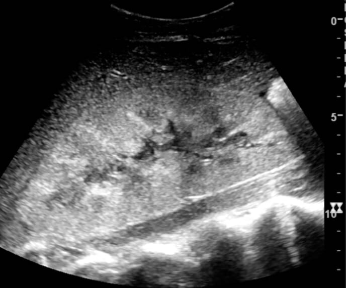 Ultrasonography of postoperative renal failure