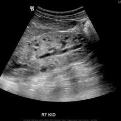 Ultrasonography of the right kidney demonstrating autosomal recessive polycystic kidney disease