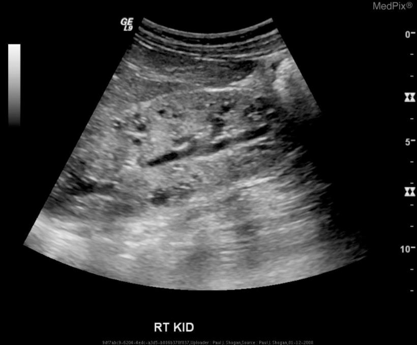 Ultrasonido del riñón derecho que demuestra una poliquistosis renal autosómica recesiva.