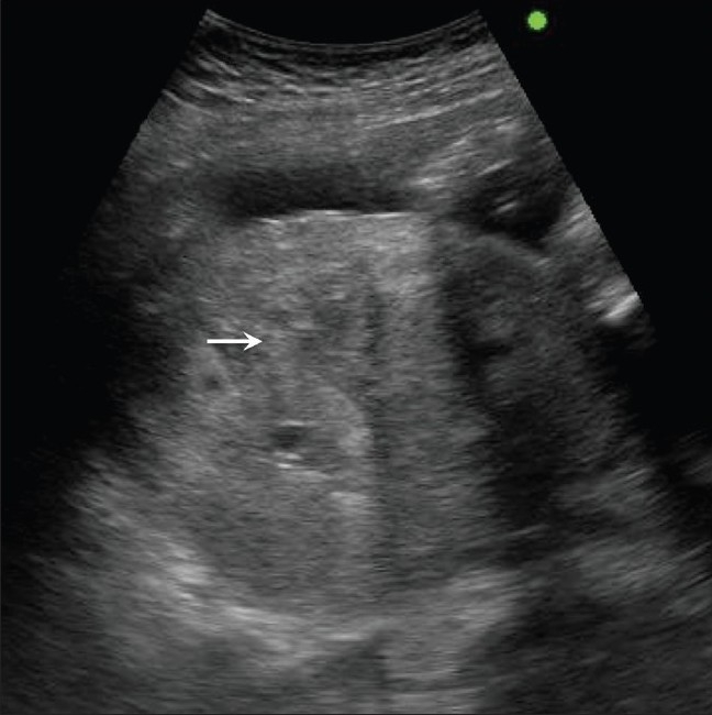 Ultrasound acute placental abruption