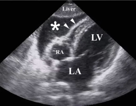 Ultrasound after chest injury showing pericardial tamponade