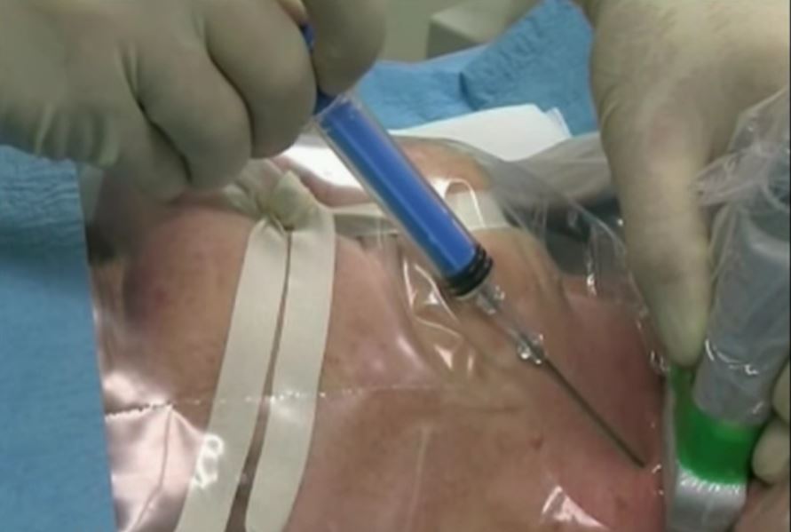 Ultrasound-guided puncture of the internal jugular vein