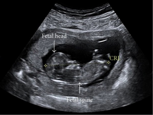Imagem ecográfica de um feto de 12 semanas