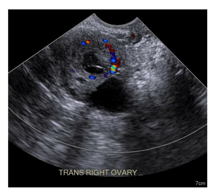 Ultrasound image of a corpus luteum cyst with thick walls and peripheral color flow on doppler