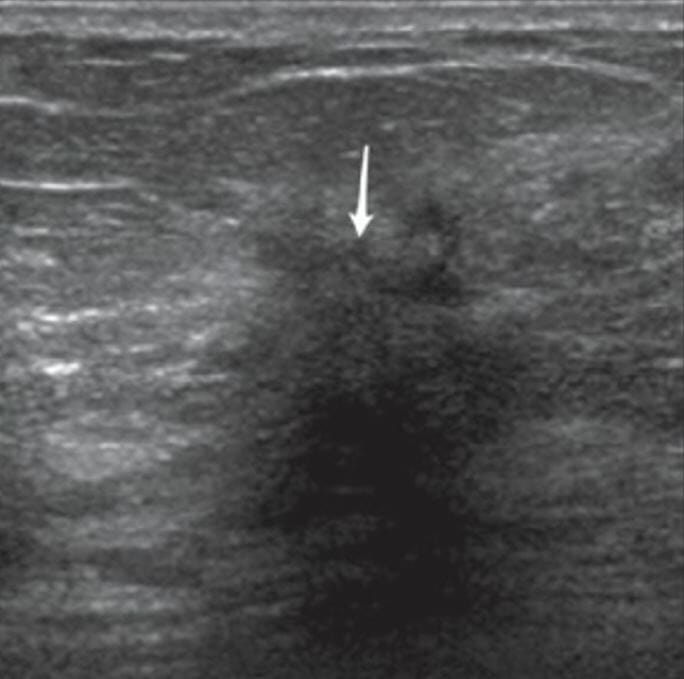 Ultrasound image of a hypoechoic mass