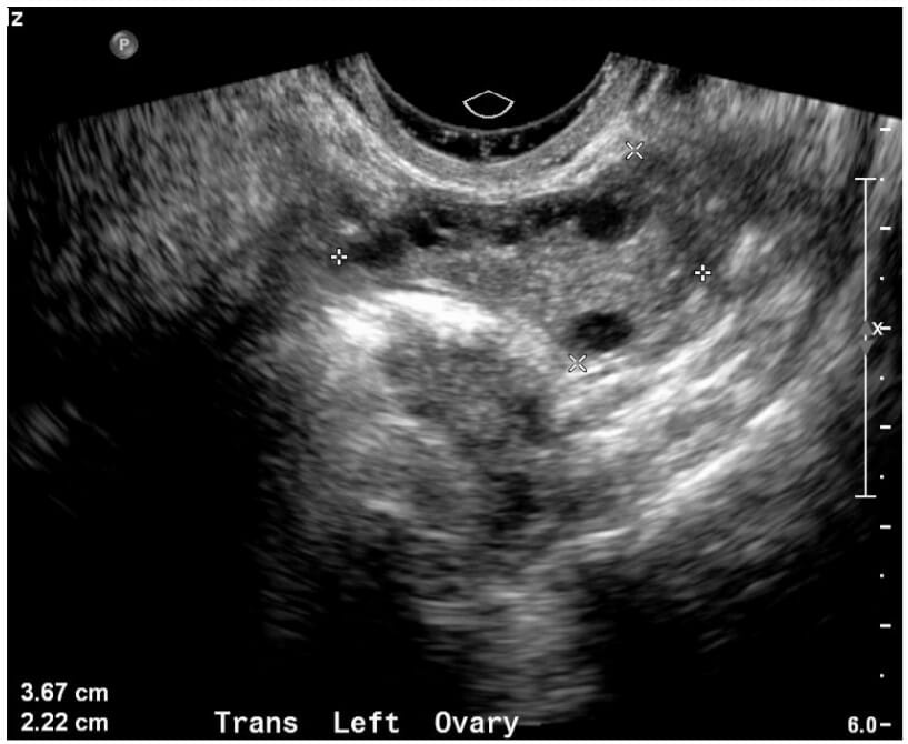 Ultrasound image of a normal ovary