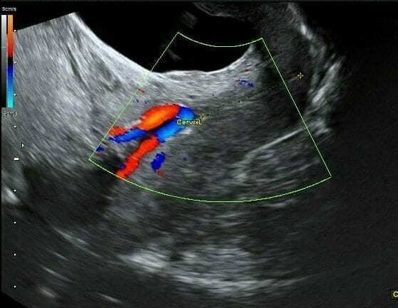 Imagem de ultra-som de um vasa previa anormalidades placentárias