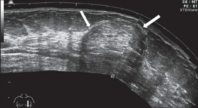 Imagem ultrassonográfica de uma massa sutilmente ecogênica bem definida