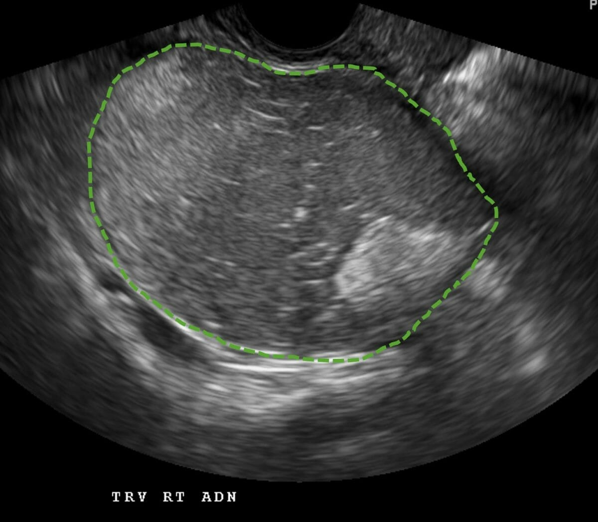 Ultrasound image showing a heterogeneous ovarian mass representing a dermoid cyst