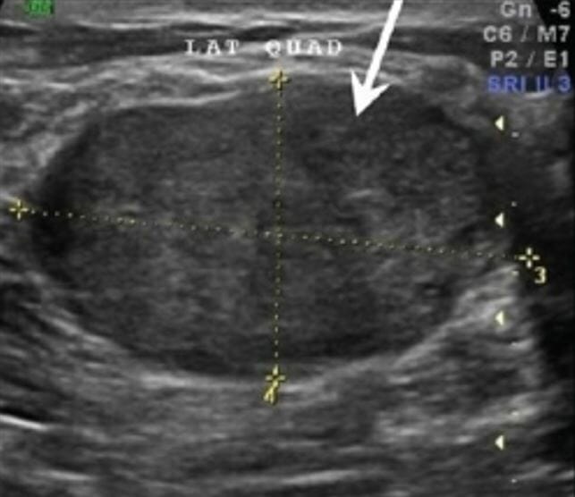 Ultrasound image showing a homogenous, hypoechoic mass that is oval-shaped and has a greater transverse diameter, suggesting a fibroadenoma