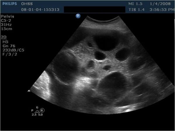 Ultrasound image showing an enlarged multicystic ovary in a patient with ovarian hyperstimulation syndrome (ohss)