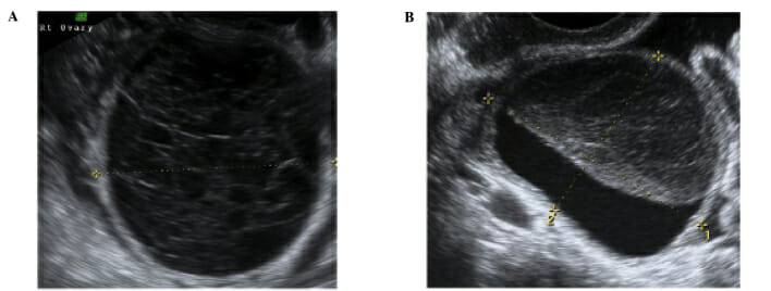 Ultrasound images demonstrating a hemorrhagic cyst