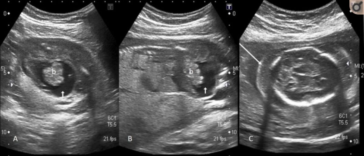 Imagens de ultra-som de uma criança com hidropisia fetal
