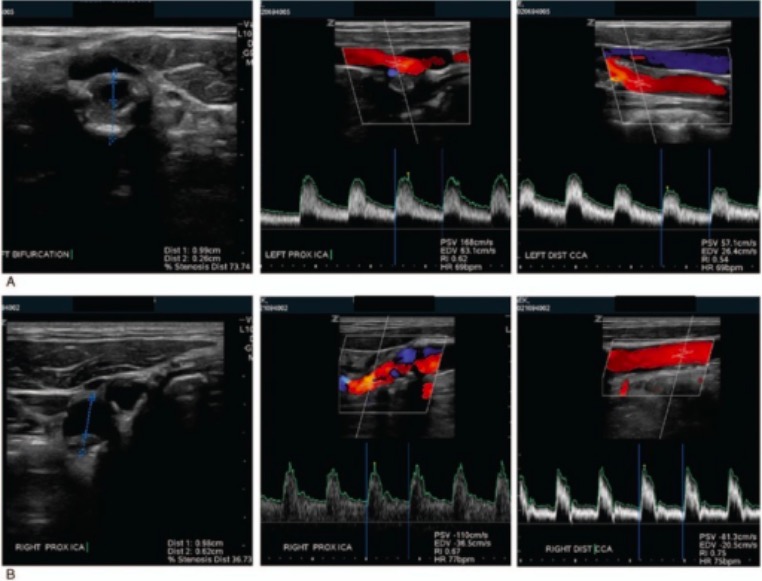 Ultrasound images of carotid artery stenosis and plaque