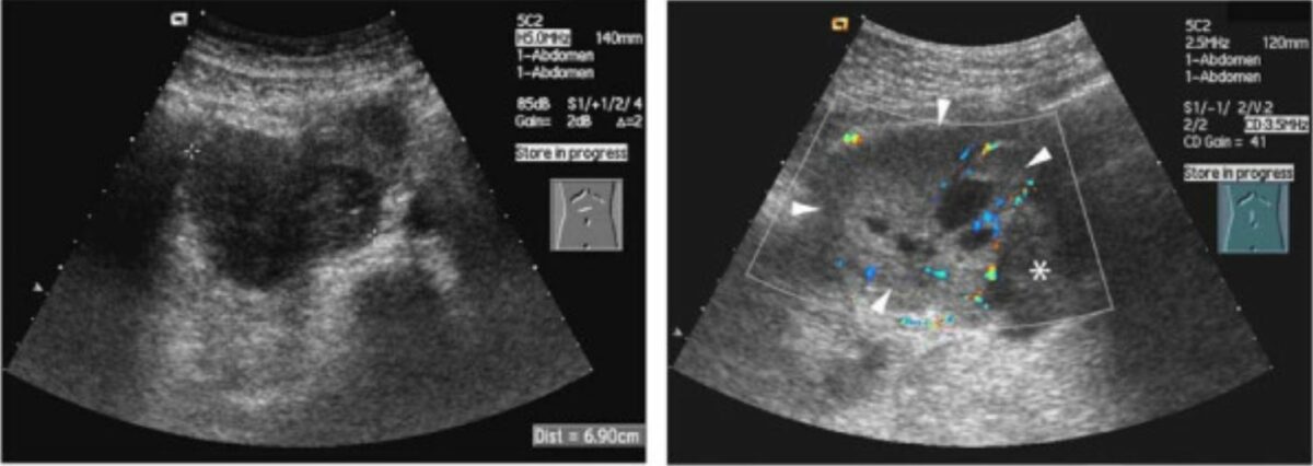 Ultrasound neuroblastoma