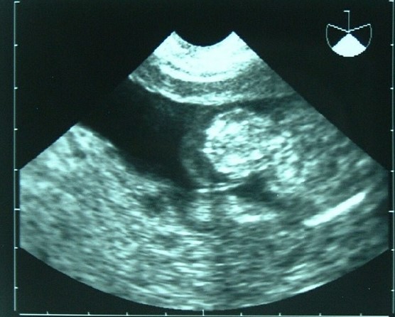 Ultrasound of a fetal omphalocele