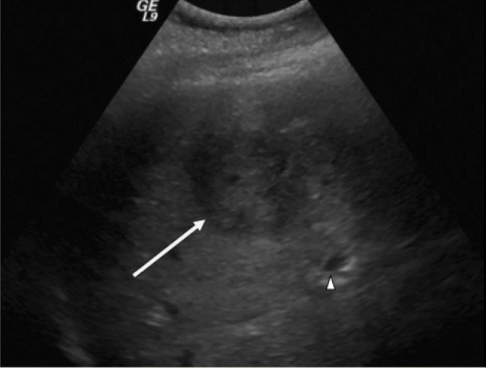 Ultrasound of a suspicious liver mass